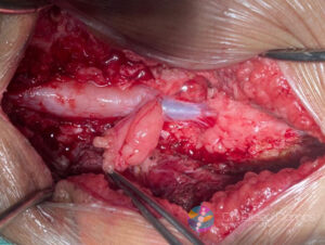 Foto intraoperatória aproximada demonstrando o defeito no fechamento ósseo da vértebra característico da espinha bífida oculta.