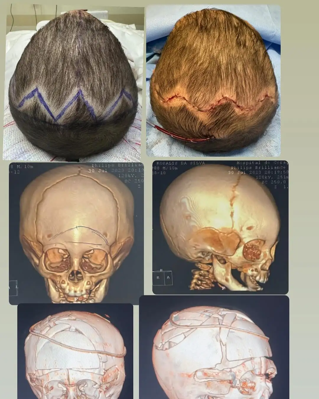 Comparativo pré-operatório e reconstrução 3D de craniossinostose tipo trigonocefalia mostrando a correção cirúrgica da testa realizada pelo Dr. Diego Ramos.