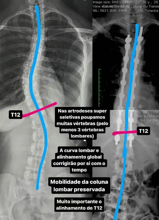 Comparativo radiológico pré e pós-operatório de cirurgia de escoliose com instrumentação posterior.