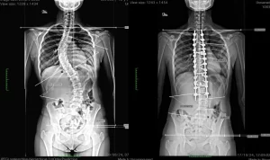 Cirurgia de Escoliose: Técnicas, Recuperação e Pós-operatório com Dr. Diego Ramos Neurocirurgião em Campo Grande MS.