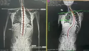 Coluna vertebral com escoliose mostrando desvio lateral e rotação das vértebras - Artigo completo sobre sintomas e tratamento com Dr. Diego Ramos Neurocirurgião Especialista em Coluna em Campo Grande MS.