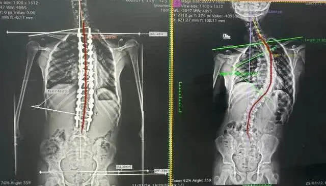 Coluna vertebral com escoliose mostrando desvio lateral e rotação das vértebras - Artigo completo sobre sintomas e tratamento com Dr. Diego Ramos Neurocirurgião Especialista em Coluna em Campo Grande MS.