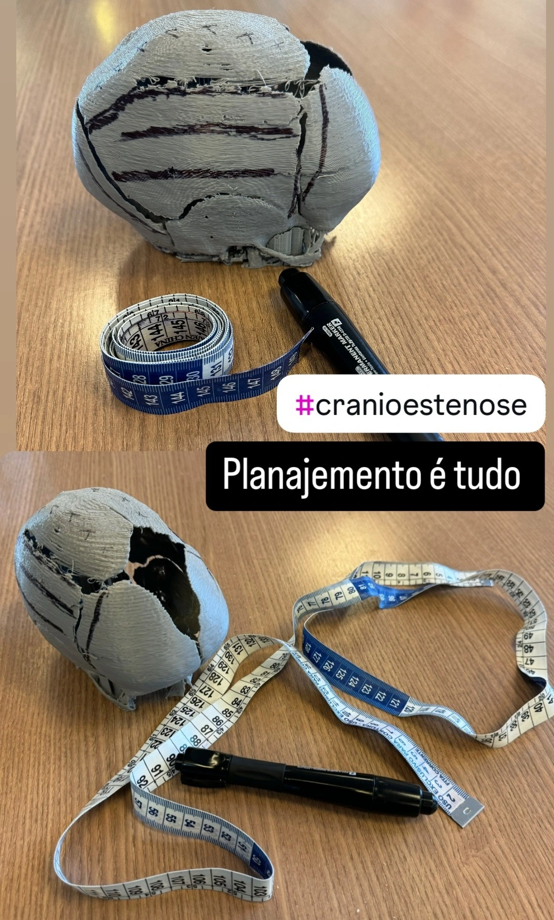 Modelo de crânio impresso em 3D (biomodelo) utilizado para o planejamento pré-operatório de cirurgia de craniossinostose pelo Dr. Diego Ramos.