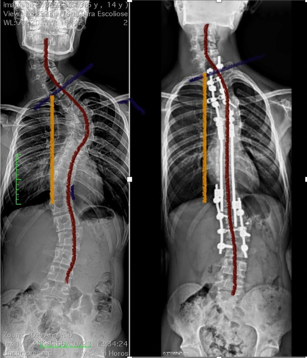 Radiografia comparativa pré e pós-operatória de cirurgia de escoliose complexa com ressecção de hemivértebras e técnica Bipolar realizada pelo Dr. Diego Ramos.