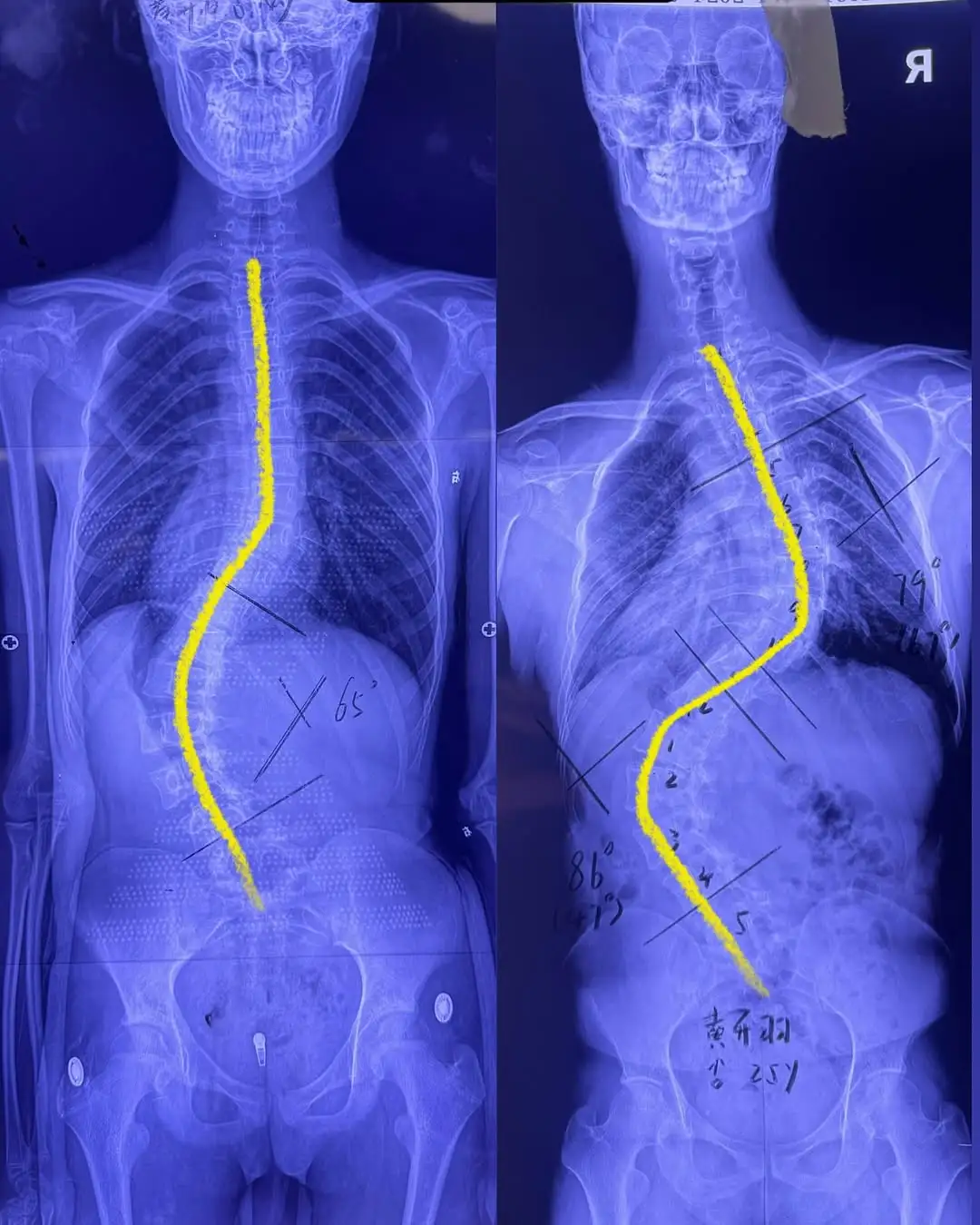 Radiografia comparativa mostrando a evolução de uma escoliose idiopática não tratada por 10 anos e a correção cirúrgica posterior com 28 parafusos realizada pelo Dr. Diego Ramos.