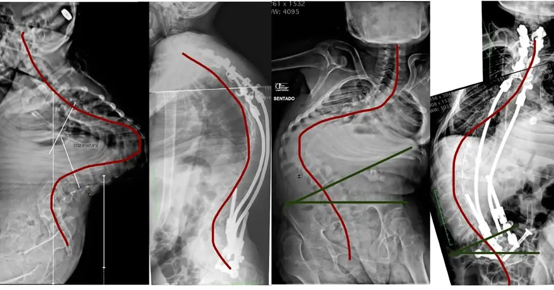 Raio-X comparativo de antes e depois de cirurgia para correção de cifoescoliose neuromuscular grave utilizando a Técnica Bipolar. A imagem mostra a redução da deformidade de 132 graus na coluna vertebral e correção da obliquidade pélvica, realizada pelo neurocirurgião Dr. Diego Ramos em Campo Grande, MS.