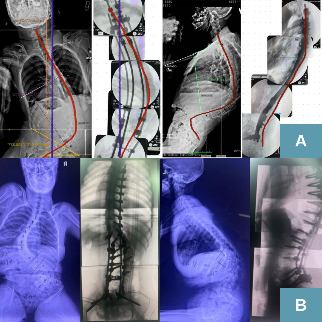 Comparativo de Raio-X em cirurgia de Escoliose Neuromuscular Grave. (A) Correção funcional com Técnica Bipolar minimamente invasiva realizada pelo Dr. Diego Ramos, focada em alinhar a bacia e permitir o sentar. (B) Exemplo de Técnica Tradicional com instrumentação em todos os segmentos vertebrais, demonstrando a maior invasividade, uso excessivo de parafusos e osteotomias em comparação à técnica bipolar.