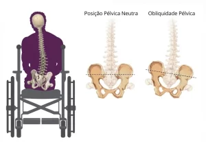 Ilustração médica comparativa para capa de artigo sobre Obliquidade Pélvica. À esquerda, representação de paciente cadeirante com escoliose neuromuscular grave e desalinhamento do quadril. À direita, esquema ósseo diferenciando uma Posição Pélvica Neutra de uma Pelve com Obliquidade (Bacia Torta).