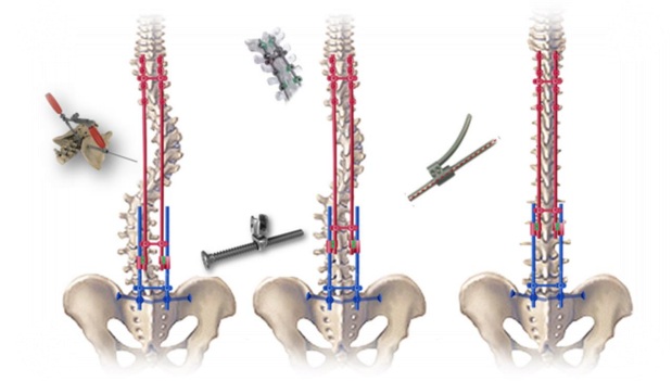 Ilustração explicativa em três etapas da instrumentação cirúrgica da coluna vertebral para correção de escoliose. A imagem detalha a inserção de parafusos pediculares, hastes e conectores em um esqueleto humano, demonstrando o processo de alinhamento e estabilização da coluna. Neurocirurgia de coluna e tratamento de deformidades vertebrais.
