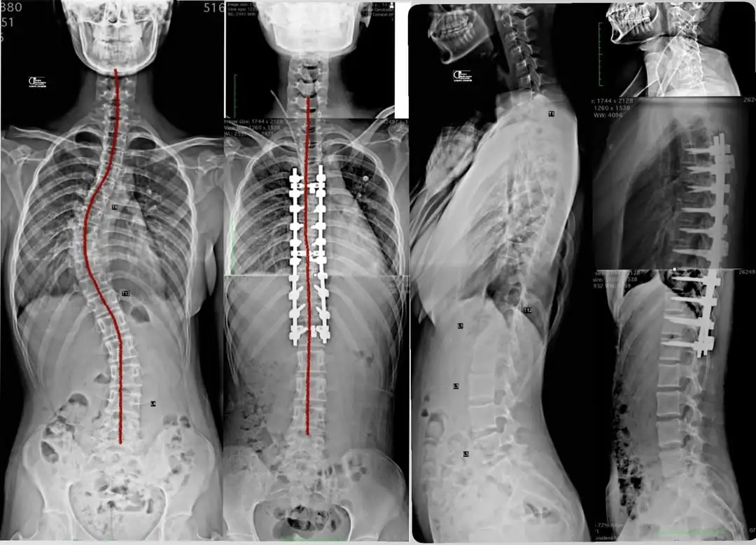 Raio-X comparativo de Artrodese Seletiva: Correção da curva torácica com preservação da coluna lombar.