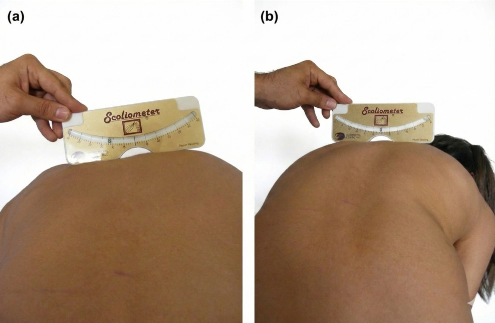 Foto de exame médico demonstrando o uso do Escoliômetro sobre a gibosidade nas costas do paciente para medir o grau de rotação da escoliose.