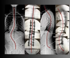Planejamento cirúrgico de escoliose lombar grave com translação, exigindo artrodese extensa para evitar adding-on.