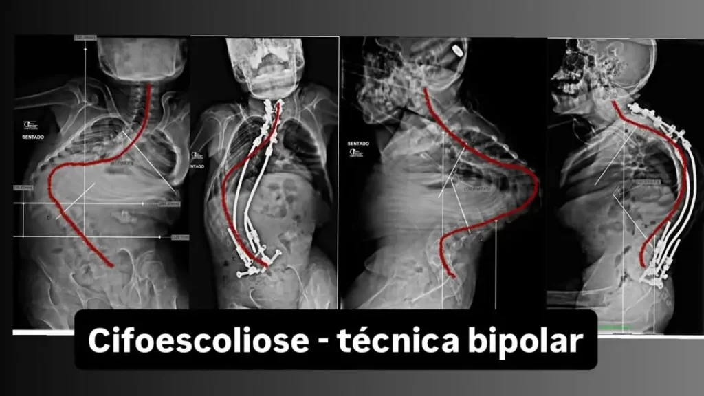 Demonstração radiográfica de correção de Cifoescoliose Neuromuscular. Imagem com fins educativos apresentando a anatomia da coluna pré e pós-procedimento neurocirúrgico.