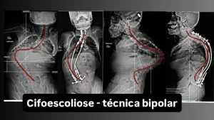 Demonstração radiográfica de correção de Cifoescoliose Neuromuscular. Imagem com fins educativos apresentando a anatomia da coluna pré e pós-procedimento neurocirúrgico.