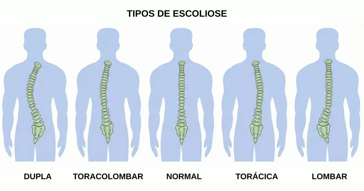 Tipos de escoliose classificados conforme a região da coluna vertebral: torácica, lombar, toracolombar e dupla