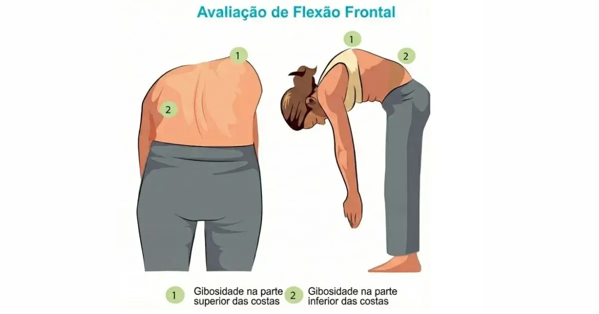 Ilustração demonstrando a avaliação de flexão frontal (Teste de Adams) para identificar gibosidade na parte superior e inferior das costas, auxiliando na percepção visual de assimetrias da escoliose.