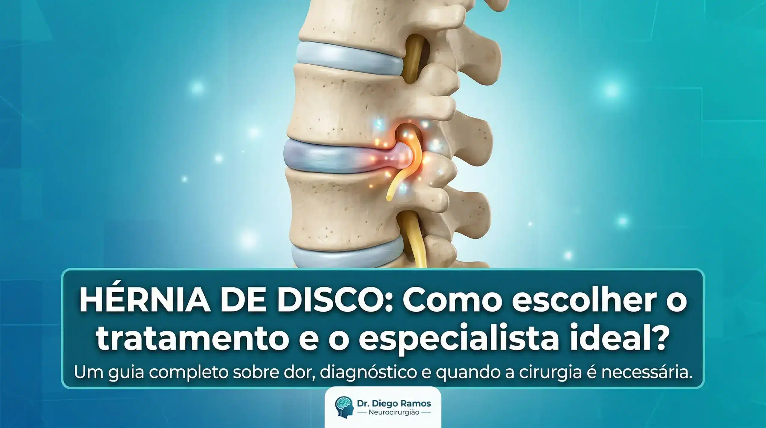 Ilustração médica de hérnia de disco lombar comprimindo nervo, usada na capa do artigo sobre tratamento da hérnia de disco com Dr. Diego Ramos, neurocirurgião em Campo Grande