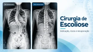 Cirurgia de Escoliose: indicação, riscos e recuperação