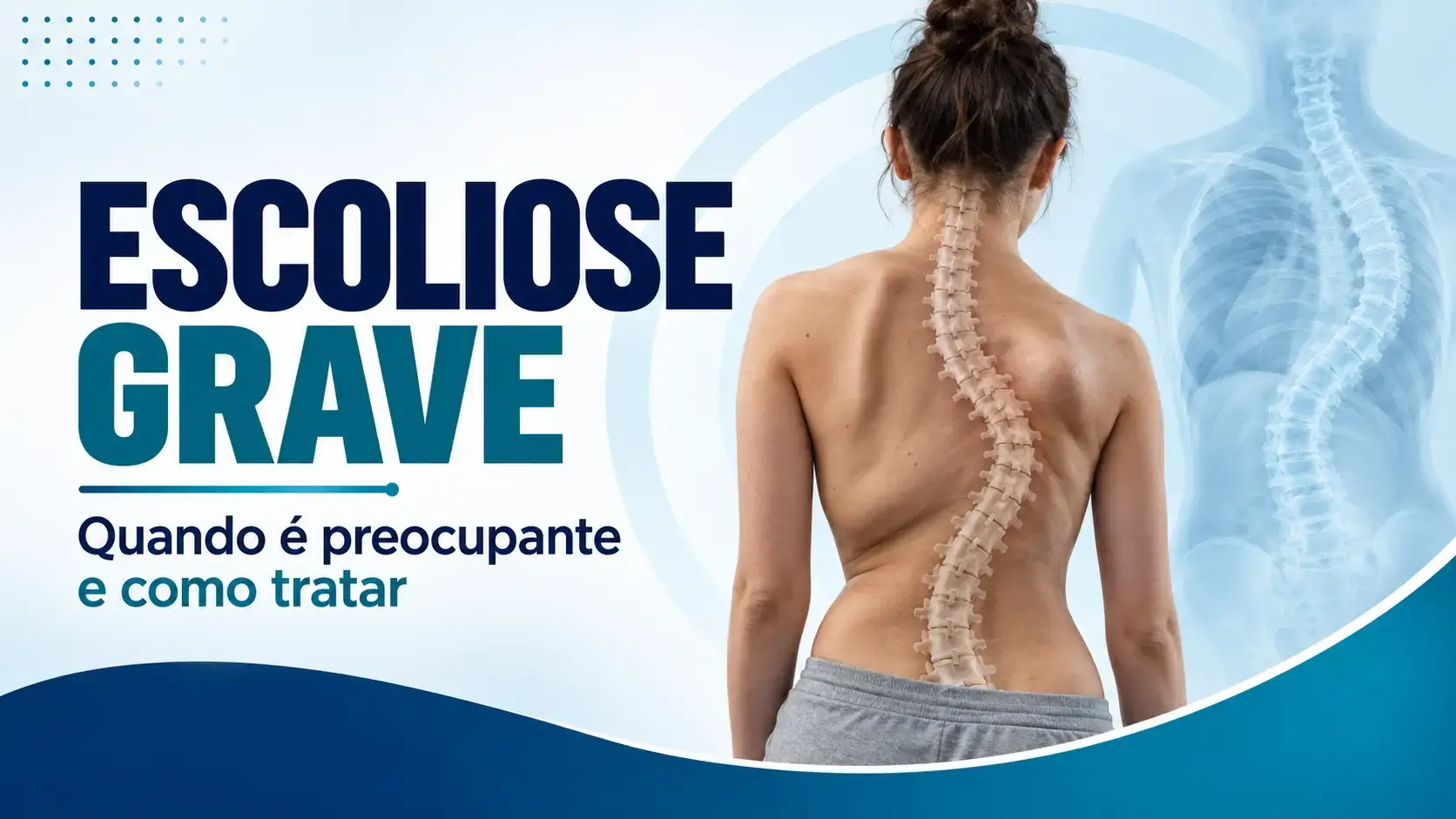 Mulher vista de costas com desvio acentuado da coluna, ilustrando um caso de escoliose grave.