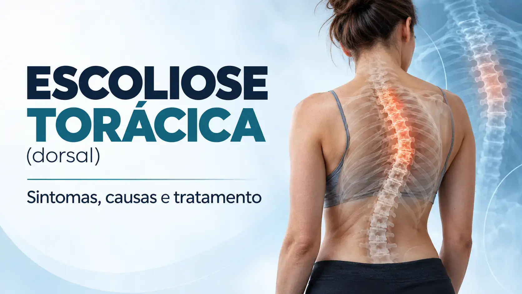 Mulher vista de costas com ilustração da coluna mostrando uma curva de escoliose na região torácica.